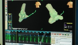 心血管内科采用三维心电解剖标测系统消融快速型房性心律失常填补医院空白