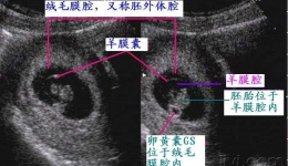 早孕期如何通过超声报告判断双胎绒毛膜性