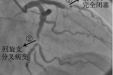 您了解冠脉造影术吗？