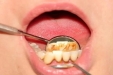 牙结石的形成与危害