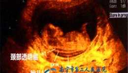 “过时不候”的胎儿NT检查