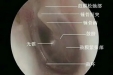 我的鼓膜穿孔了，需要立即手术修补吗？