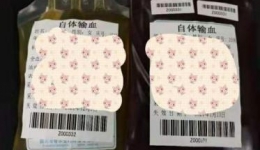术前储存式自体输血：自己为自己备血