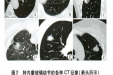体检发现肺结节怎么办？肺结节是良性还是恶性？