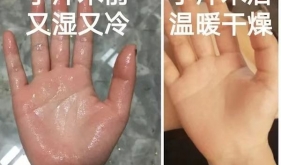 微创治疗手汗症，告别“水手”生活