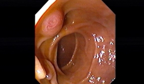 胃大部分切除术胃毕II式术后胆总管大结石,内镜下微创手术成功取出