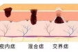 科普 | 人各有“痣”：你了解身上的痣吗？