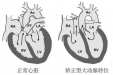 我院完成首例矫正型大动脉转位伴心脏明显右转位房颤射频消融术