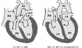 我院完成首例矫正型大动脉转位伴心脏明显右转位房颤射频消融术
