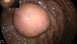 小手术大效果，胃间质瘤新治疗——内镜下黏膜剥脱术