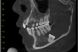 左下颌骨囊肿开窗术合并完整拔除超低位埋伏阻生牙一例