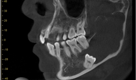 左下颌骨囊肿开窗术合并完整拔除超低位埋伏阻生牙一例