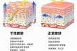 干皮如何护肤？