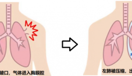 莫生气，肺真的可能会其“炸”——自发性气胸值得您了解