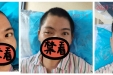 外伤后眼睛睁不开动不了怎么办？注射治疗有奇招！（补6月）