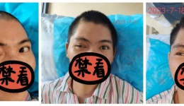 外伤后眼睛睁不开动不了怎么办？注射治疗有奇招！（补6月）