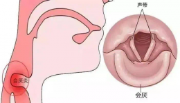 耳鼻喉科三大急症之“急性会厌炎”