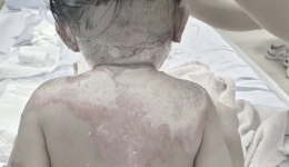 惊险！4岁女孩趴桌致烫伤，烧烫伤急救谨记远离“民间偏方”科学处置